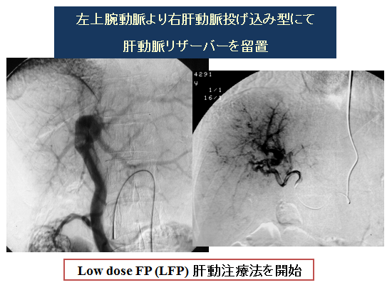 Low dose FP療法