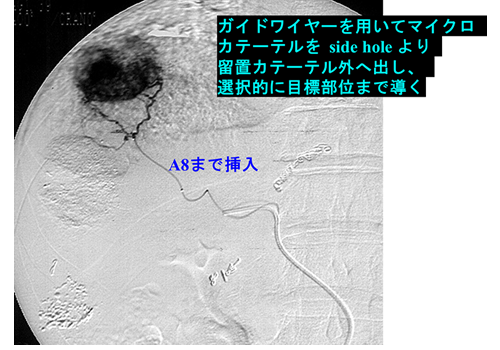 システム-Iによりピンポイントで腫瘍部位に薬剤投与が可能となりました