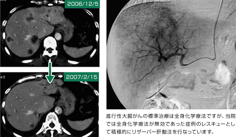 60歳 女性 大腸がん肝転移