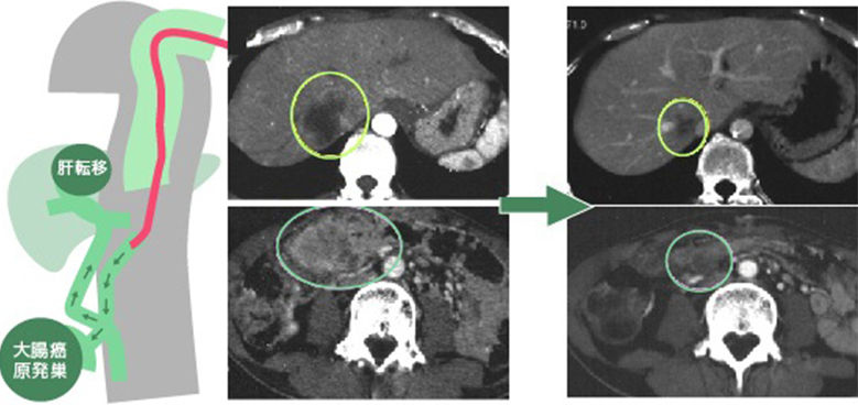 肝臓以外に存在する切除不能のがん病巣に対する動注療法