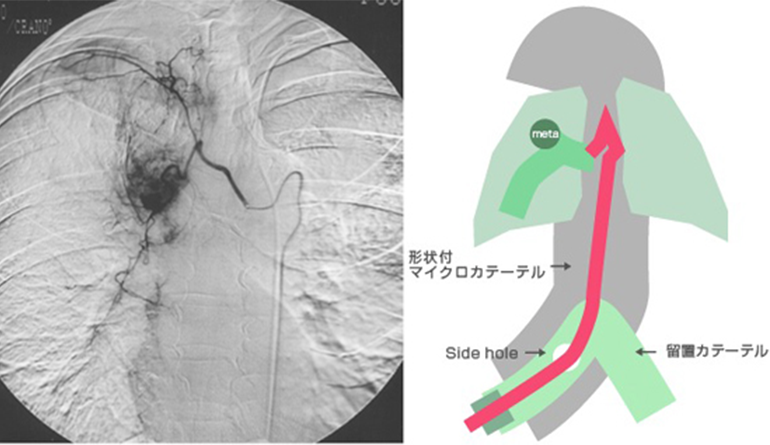 肝臓以外に存在する切除不能のがん病巣に対する動注療法