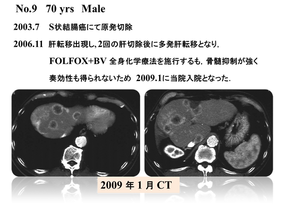 Case No.9 70歳男性