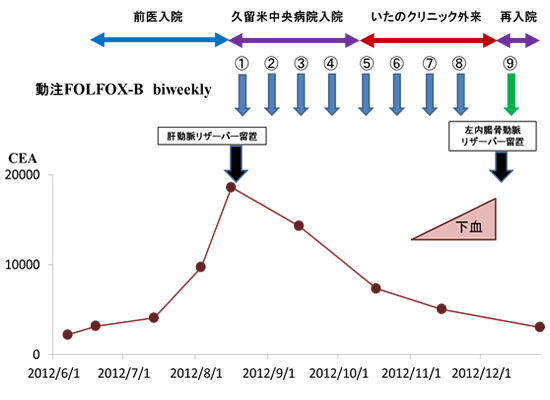 動注FOLFOX-Bが著効した末期的直腸癌肝転移の1例