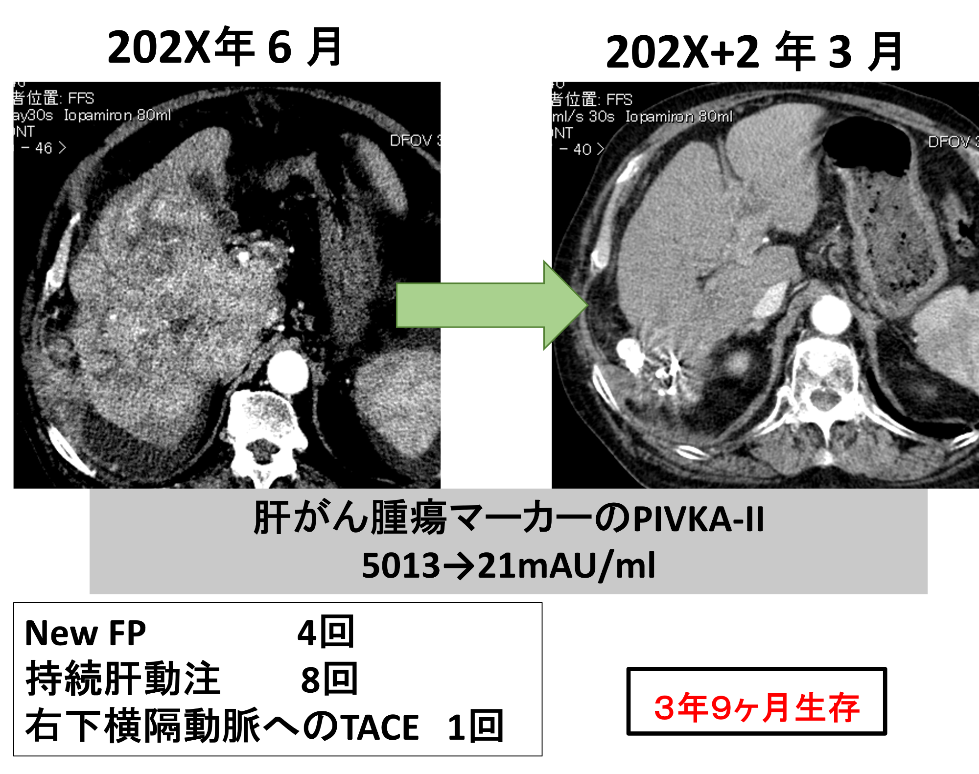 肝臓以外に存在する切除不能のがん病巣に対する動注療法